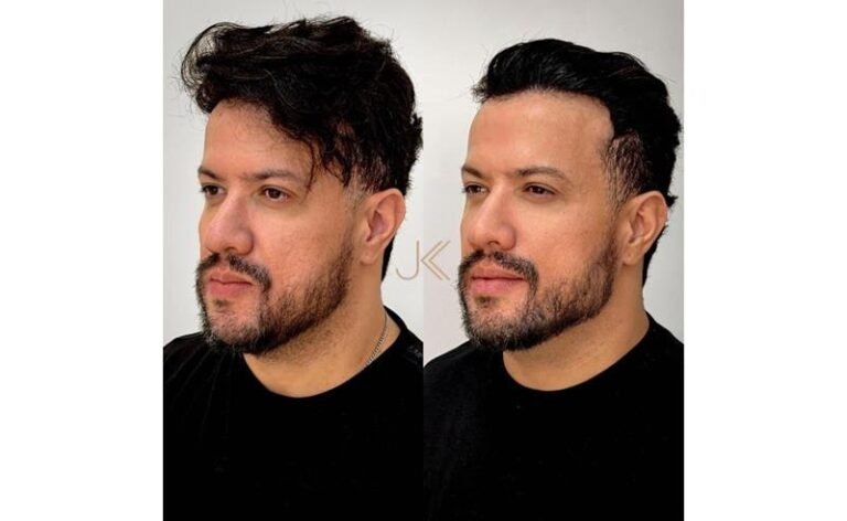 Cantor Victor Hugo, do hit “Tubarões”, surpreende fãs ao revelar harmonização facial feita na JK Estética Avançada